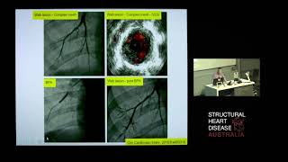 Balloon Pulmonary Angioplasty for CTEPH  Dr David Boshell [upl. by Lorrad]