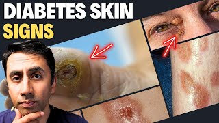 Doctor Explains 13 Skin Signs of Diabetes  Never Ignore These Symptoms High Sugar [upl. by Ecnerret909]