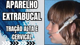 Quais os efeitos do AEB ou Aparelho Extra Bucal na dentição dos pacientes Aula 175 [upl. by Ethban224]