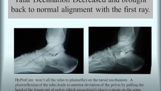 HyProCure® Before amp After TaloTarsal Stabilization [upl. by Hazrit]