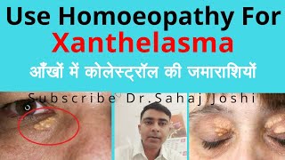 Xanthelasma Homeopathic medicine for Xanthelasma [upl. by Bradford247]