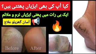 Cracked heels treatment at home made remedy  phati ario ka ilaj [upl. by Whatley]