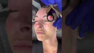 CO2 Laser Resurfacing Around The Eyes  Dr Medispa [upl. by Rodmur]