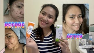 How I cleared my skin for 3 months epiduo gel forte Azelaic acid [upl. by Whiteley]