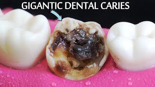 INCREDIBLY SATISFYING Restoration Of Massive Tooth Decay  Root Canal And Crown Process [upl. by Anahcar480]