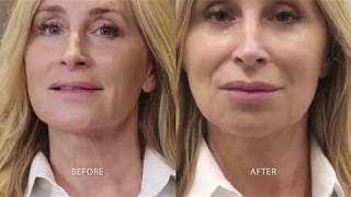 TempSure 20 Minute NonSurgical Face Lift [upl. by Diamante817]