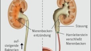 Nierenbeckenentzündung oder Pyelonephritis [upl. by Atikal]