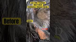 Lice nits removal treatment  lice treatment  lice removal  lice how to remove the nits from hair [upl. by Hallsy]