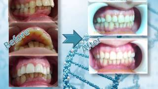 العلاج التقويمي للبروز الشديد في الأسنان العلوية Orthodontic treatment of severe protrusion [upl. by Fevre]