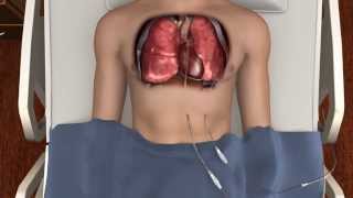 How to Prevent Chest Tube Occlusion  PleuraFlow ACT [upl. by Dominik]