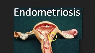 Endometriosis [upl. by Maloy]