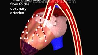 Cardiogenic Shock and Intraaortic Balloon Pump by Dr Cal Shipley MD [upl. by Anne-Marie]