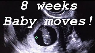 8 weeks ultrasound Baby moves [upl. by Cherian264]