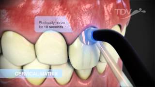 CERVICAL MATRIX TDV  Class V Restorations [upl. by Miarhpe]