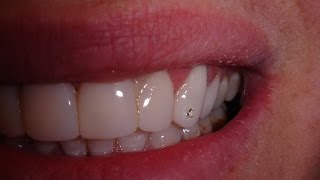 Dental Composite veneers time lapse  spot the real Diamond [upl. by Heddi]