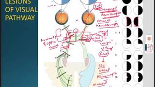 LESIONS amp CLINICAL ANATOMY OF VISUAL PATHWAY [upl. by Yboj]