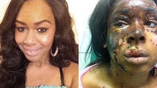 Lasting Pain Of Acid Attack Victim [upl. by Nedyrb]