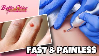 Warts Electrocautery Removal Procedure Bella Chica Beauty Studio [upl. by Bow973]