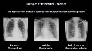 How to Interpret a Chest XRay Lesson 7  Diffuse Lung Processes [upl. by Trista233]