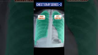 Ideal Chest XRAY  Chest Xray series part 2 [upl. by Giguere]