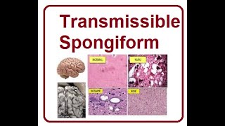 Transmissible Spongiform  2024 [upl. by Ecinerev184]