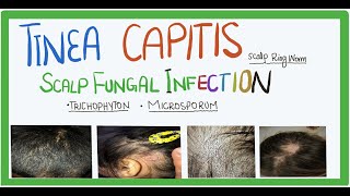 Tinea Capitis fungal infection of scalp causes transmission clinical features and Treatment [upl. by Noble]