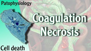 Pathophysiology  Coagulation Necrosis Hani Laith شرح [upl. by White]