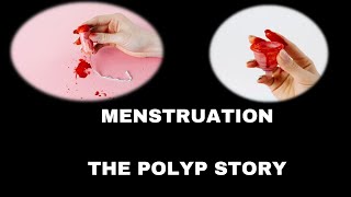 Polyps  Endometrial  Cervical  Abnormal uterine bleeding  Heavy menses  Causes [upl. by Adolphus577]