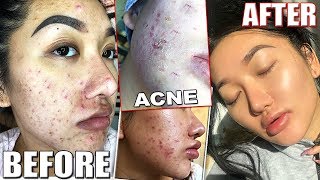 MY ACNE STORY ACCUTANE JOURNEY FOR THE SECOND TIME  SIDE EFFECTS ACCUTANE SKINCARE [upl. by Orren764]