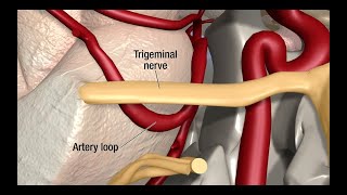 Treatment for Trigeminal Neuralgia UCSF Neurosurgery [upl. by Saucy]