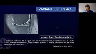Nomenclatura de lesión meniscal [upl. by Nalehp]