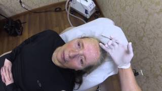 Botox Injections Brow Lift  Huntington Long Island NY Plastic Surgeon [upl. by Imojean]