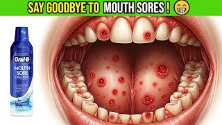 Say Goodbye to Mouth Sores 😁 OralB Mouth Sore Mouthwash with Hydrogen Peroxide Review🌟 [upl. by Sommer576]