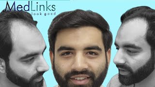 MedLinks Hair Transplant Results  Before and After Hair Transplant Results  Dr Gaurang Krishna [upl. by Nnyltak]