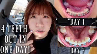 4 PREMOLARS EXTRACTED IN ONE DAY ONE WEEK HEALING PROCESS VLOG  Adult Braces [upl. by Stroud393]