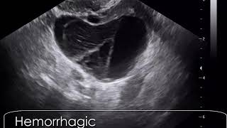 case 609 Hemorrhagic corpus luteum cyst CLC [upl. by Armalda247]