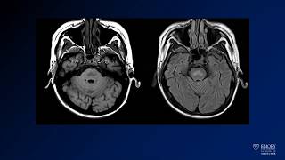 Neuroradiology board review lecture 1 case 19 [upl. by Annaliese369]