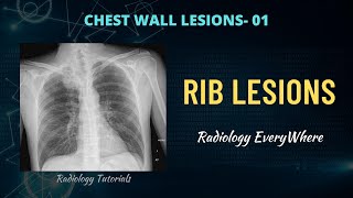 Rib Lesions Radiology Tutorials  Benign and Aggressive Rib Lesions  Radiology Everywhere [upl. by Territus]