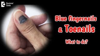 Bluish discoloration of nails What does it mean Dr Rajdeep Mysore [upl. by Senoj]