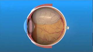 Pneumatic Retinopexy [upl. by Weinberg]