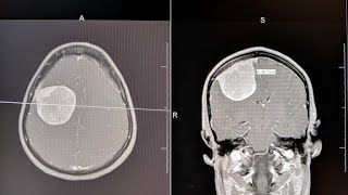 Brain Tumor Symptoms Described [upl. by Vasti740]