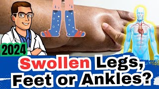 1 Cause of Swollen Ankles Legs or Feet What Causes It Dangers [upl. by Klemm]