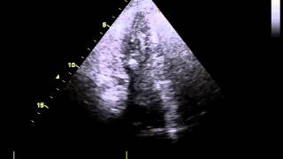 Video 1  Cardiac platypneaorthodeoxia syndrome in a 73yearold woman [upl. by Eboj]