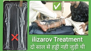 ILIZAROV TREATMENT IN Nonunion fracture ilizarovsurgery fracture नही जुड़े फ्रेक्चर का इलाज [upl. by Anawed]