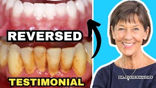 Gum Recession and Bone Loss Reversed Testimonial [upl. by Poul]