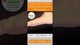 eswt hilterapi superinduktifsistem topukdikeni [upl. by Latsyrd641]