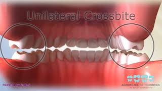 Posterior Crossbite [upl. by Hurlee689]