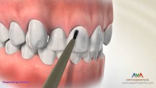 Putting Orthodontic Braces On or Bonding  Indirect vs Direct Technique [upl. by Aihsotal107]