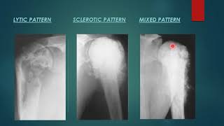 Osteosarcoma x ray appearance [upl. by Sihonn]