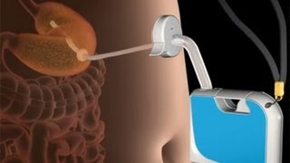 Home Stomach Pump to End Obesity [upl. by Adianez]